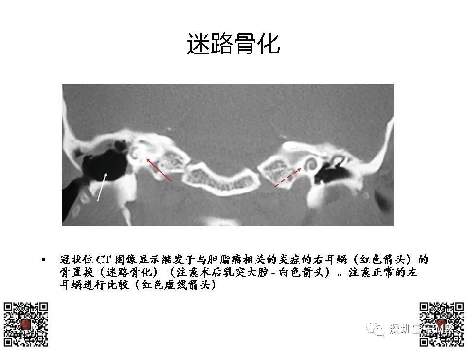 影像PPT - 【PPT】感音性听力损失的影像检查-8