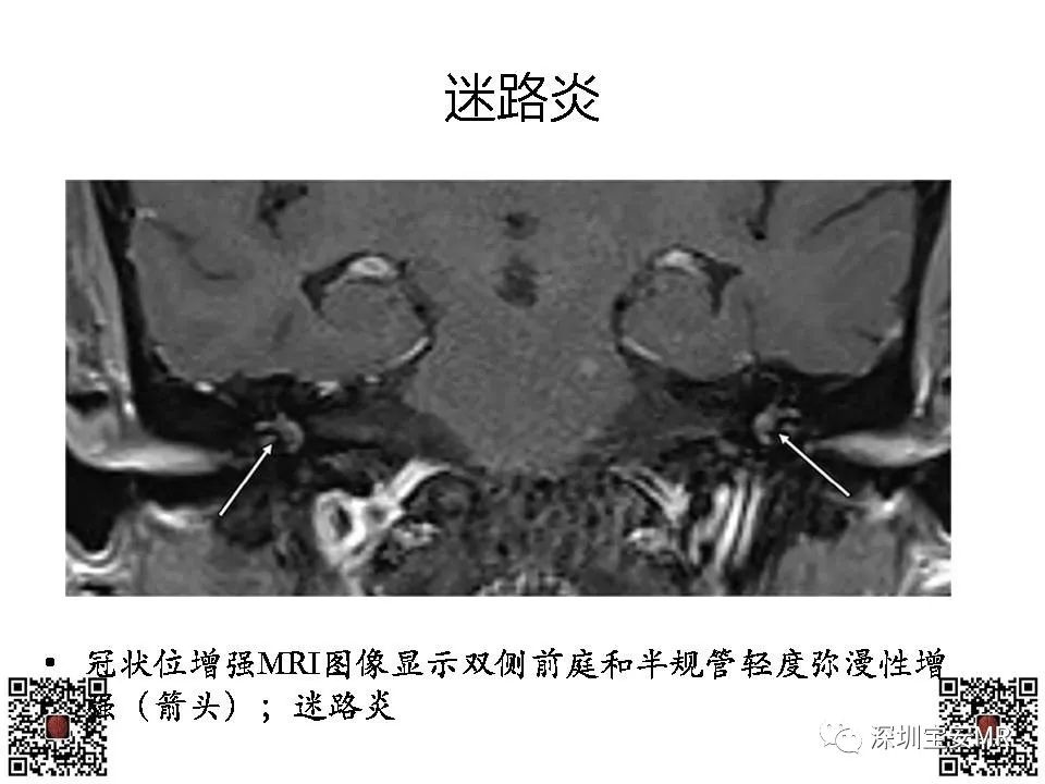 影像PPT - 【PPT】感音性听力损失的影像检查-9