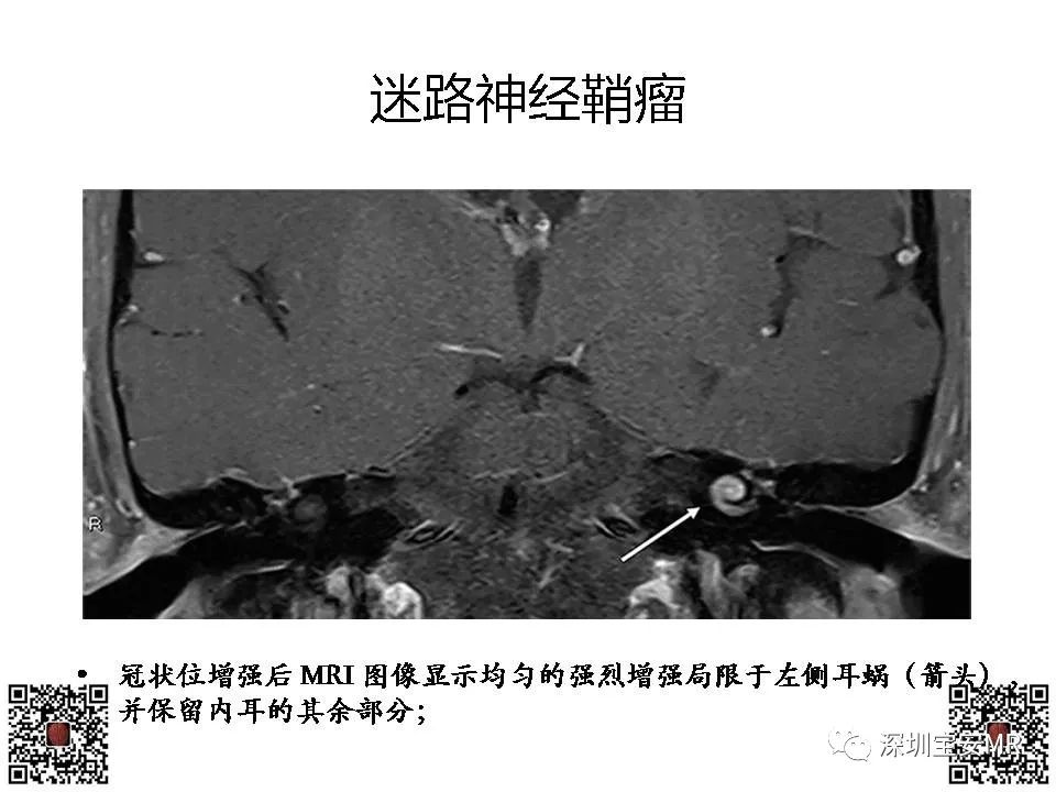 影像PPT - 【PPT】感音性听力损失的影像检查-10