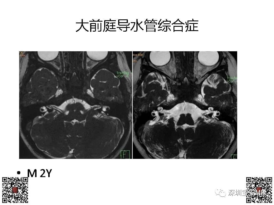 影像PPT - 【PPT】感音性听力损失的影像检查-11