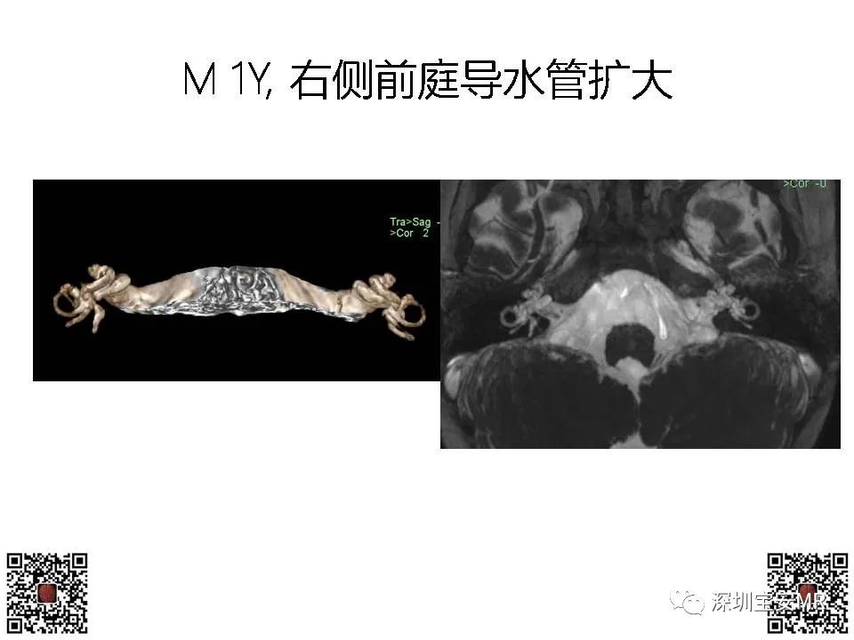 影像PPT - 【PPT】感音性听力损失的影像检查-12