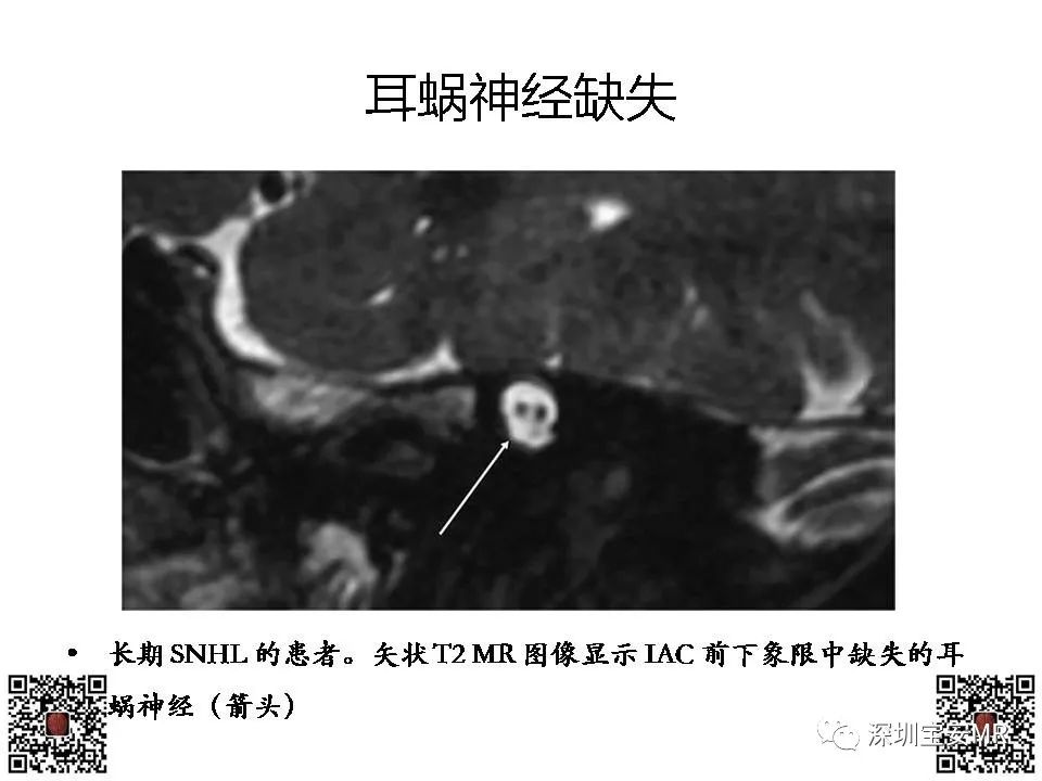影像PPT - 【PPT】感音性听力损失的影像检查-17