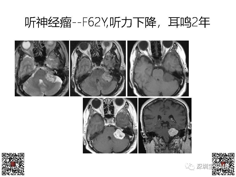影像PPT - 【PPT】感音性听力损失的影像检查-18