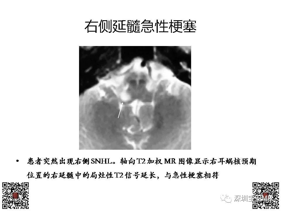 影像PPT - 【PPT】感音性听力损失的影像检查-20