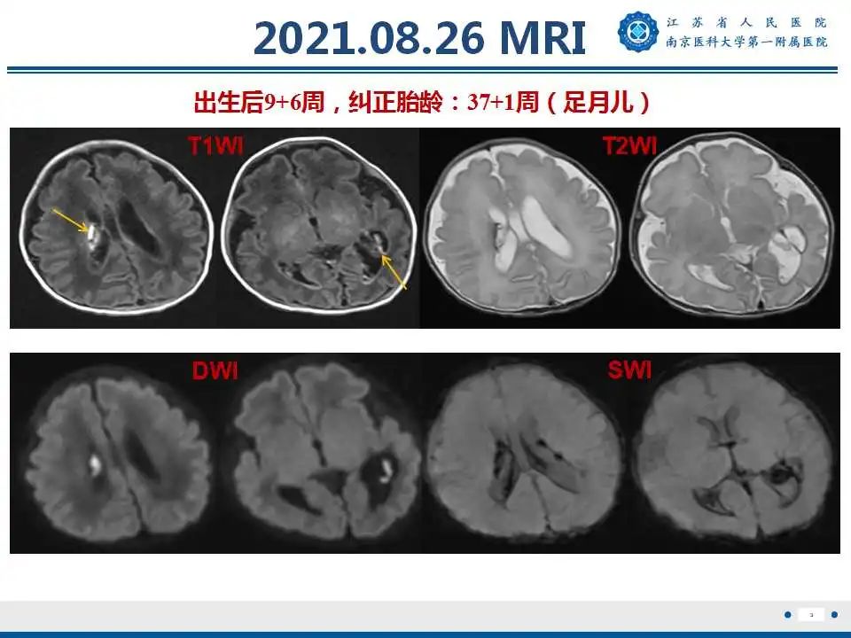 影像PPT - 【PPT】生发基质-脑室内出血-4