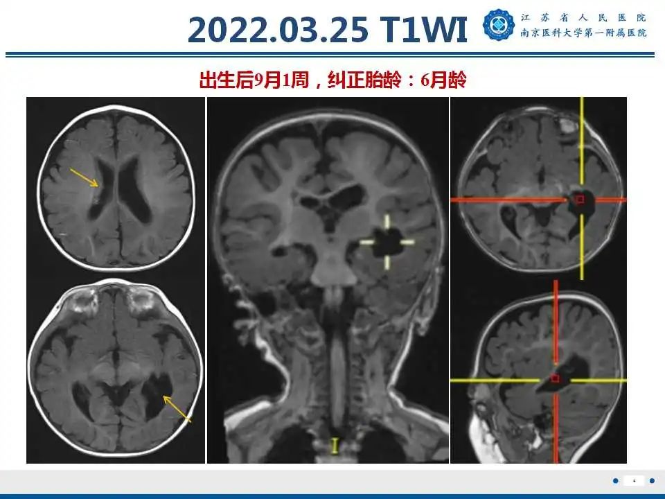 影像PPT - 【PPT】生发基质-脑室内出血-5