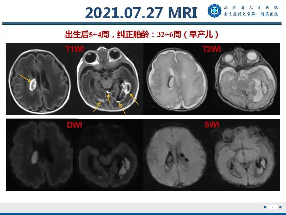 影像PPT - 【PPT】生发基质-脑室内出血-3