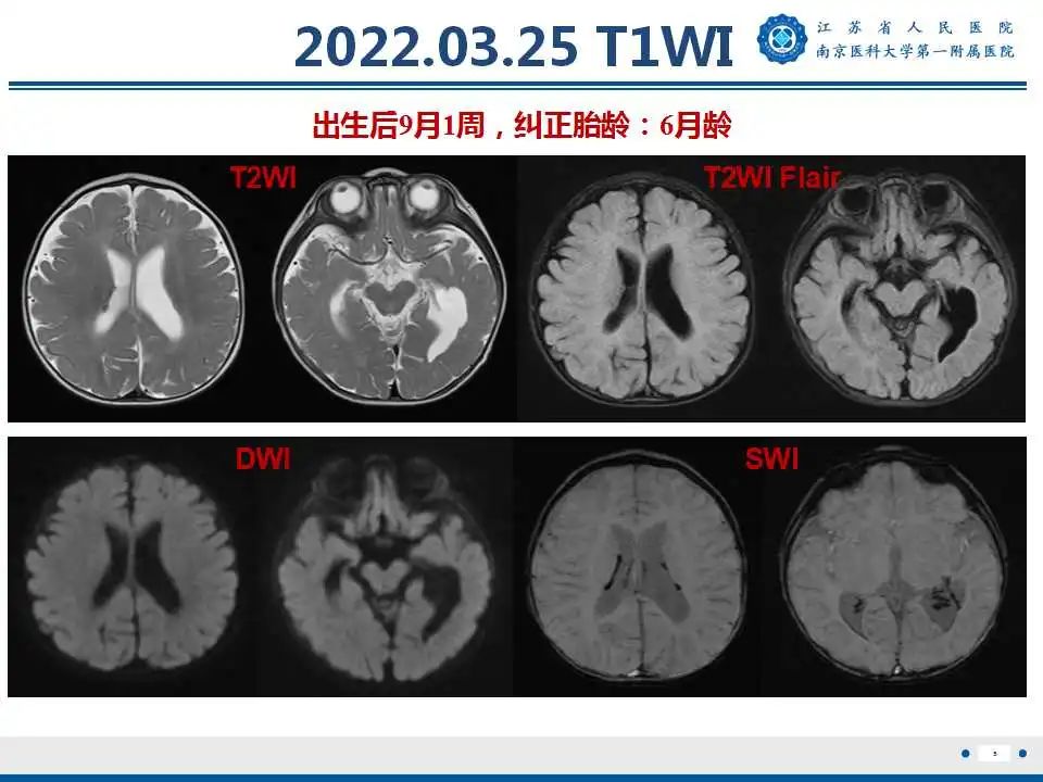 影像PPT - 【PPT】生发基质-脑室内出血-6