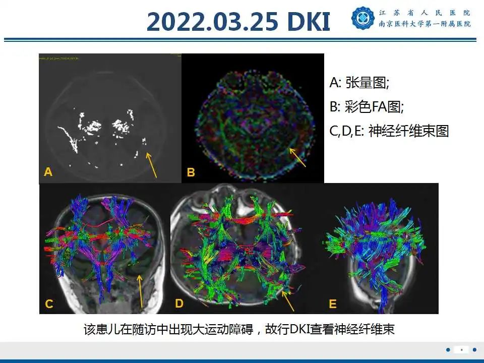 影像PPT - 【PPT】生发基质-脑室内出血-7
