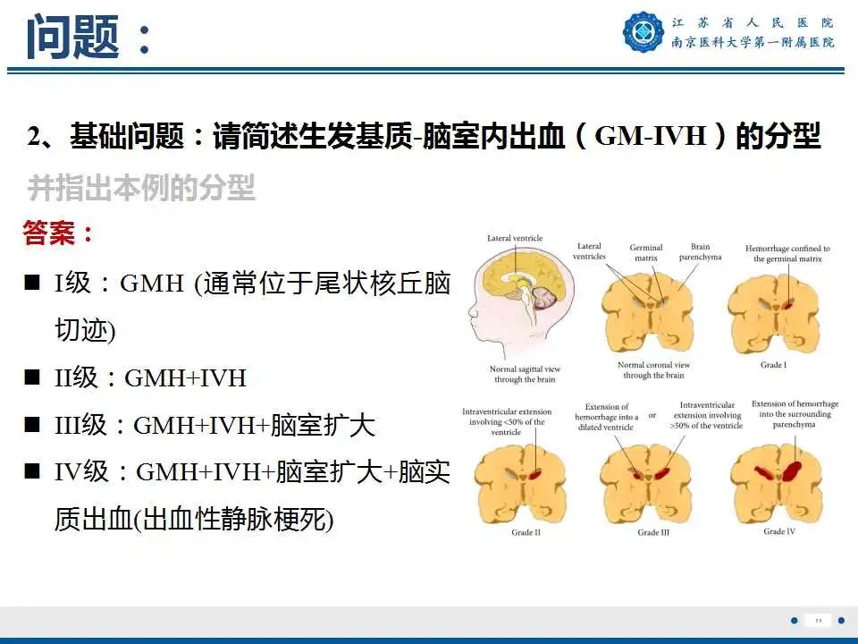 影像PPT - 【PPT】生发基质-脑室内出血-12