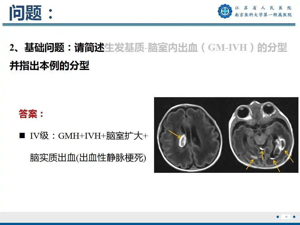 影像PPT - 【PPT】生发基质-脑室内出血-13