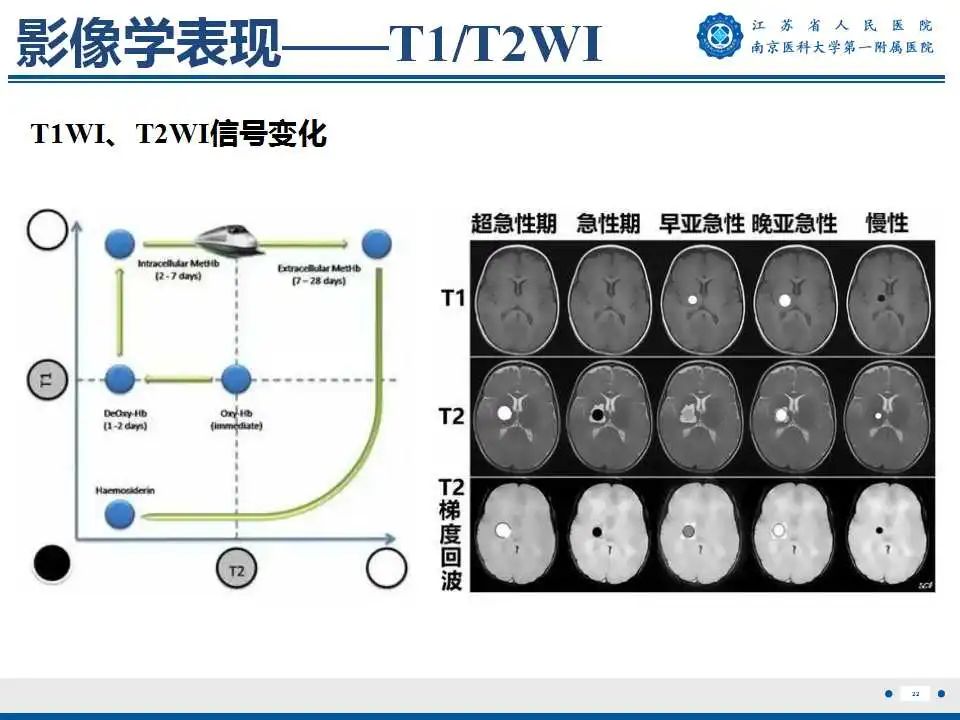 影像PPT - 【PPT】生发基质-脑室内出血-23