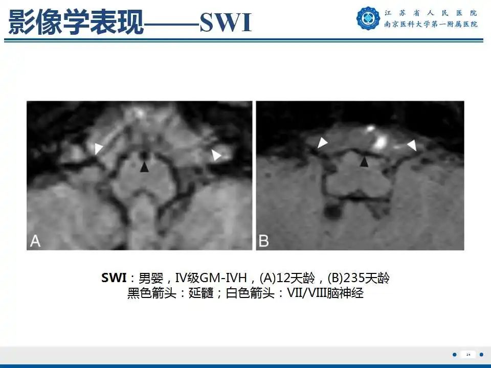 影像PPT - 【PPT】生发基质-脑室内出血-25