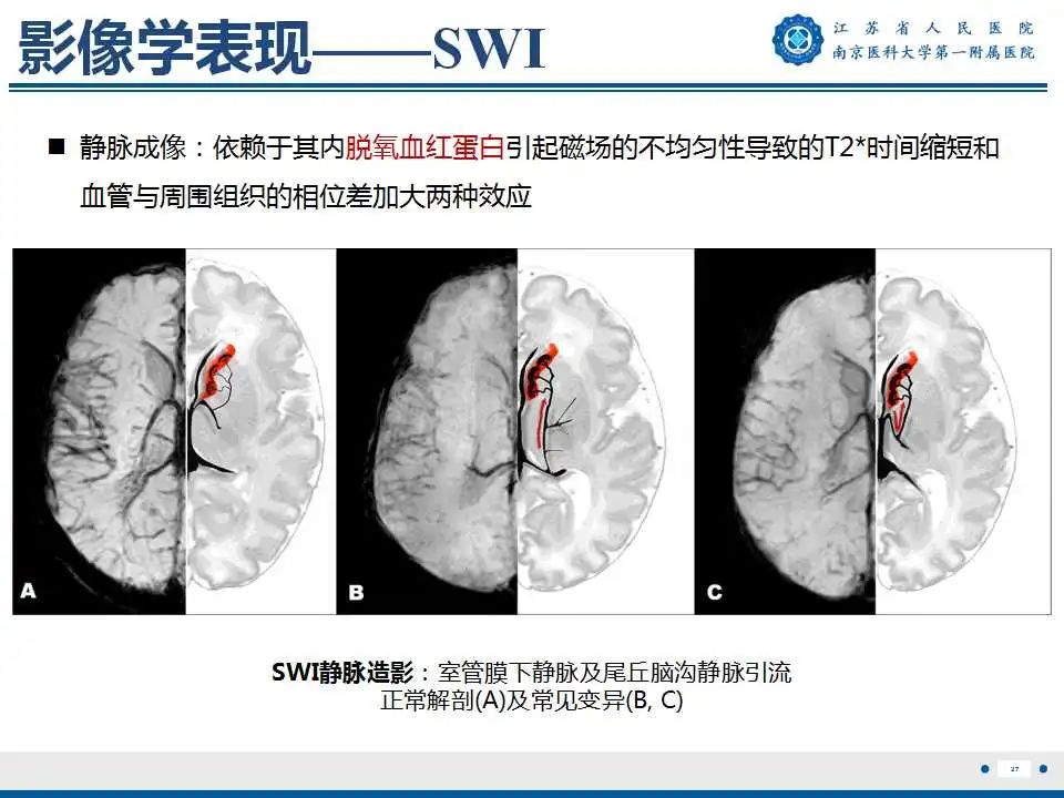 影像PPT - 【PPT】生发基质-脑室内出血-28