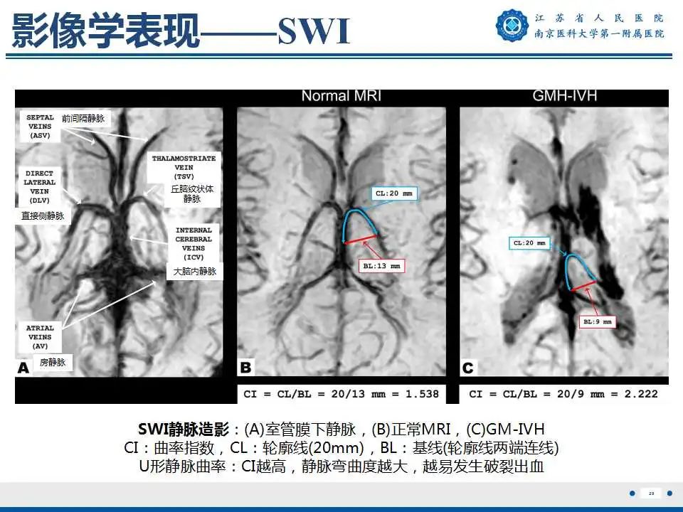 影像PPT - 【PPT】生发基质-脑室内出血-29