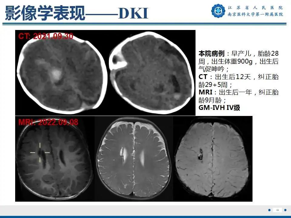 影像PPT - 【PPT】生发基质-脑室内出血-34