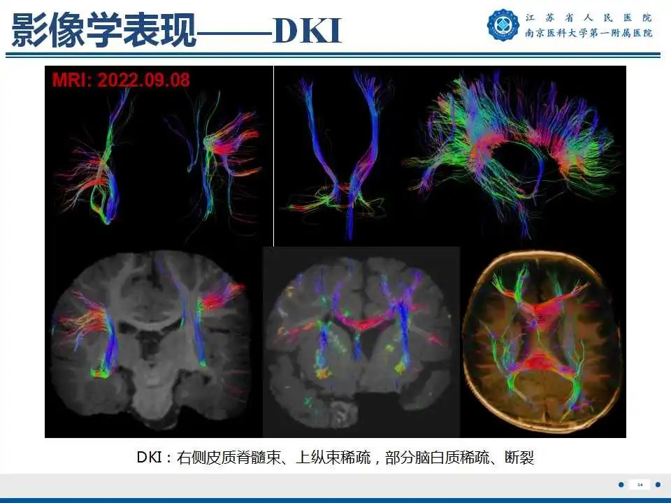 影像PPT - 【PPT】生发基质-脑室内出血-35