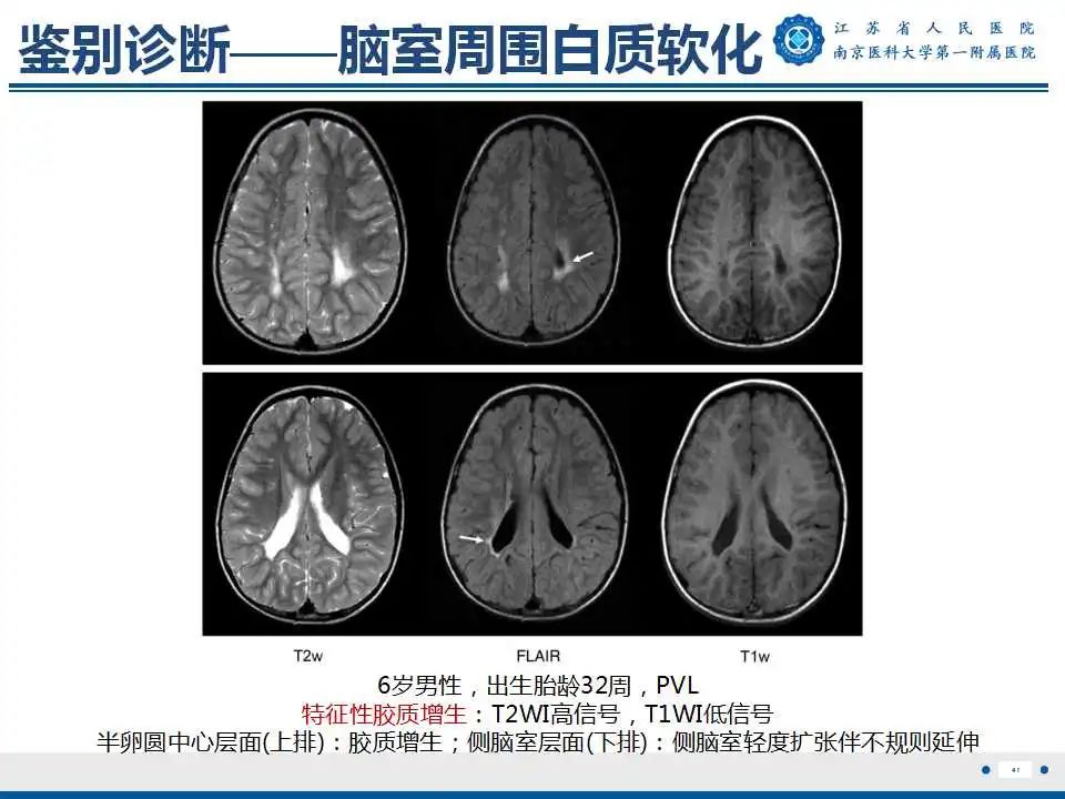 影像PPT - 【PPT】生发基质-脑室内出血-42
