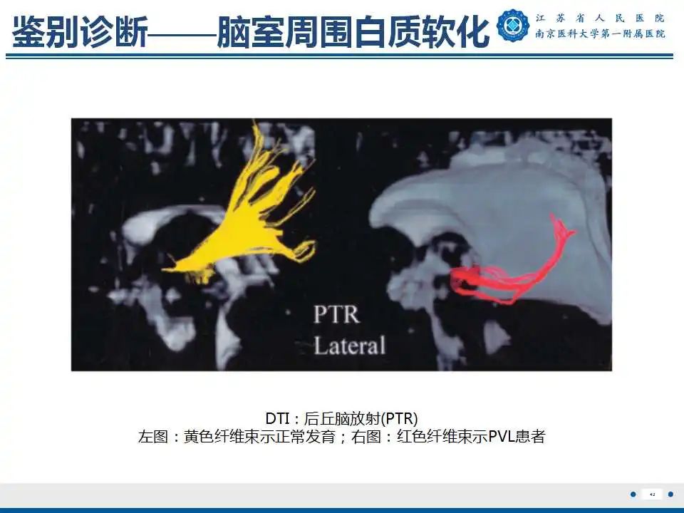影像PPT - 【PPT】生发基质-脑室内出血-43