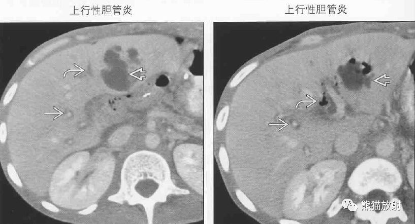 影像PPT - 肝门静脉周透亮或水肿(门静脉周围间隙增宽)-4 影像PPT - 肝门静脉周透亮或水肿(门静脉周围间隙增宽)-4
