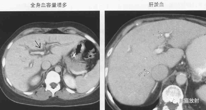 影像PPT - 肝门静脉周透亮或水肿(门静脉周围间隙增宽)-2 影像PPT - 肝门静脉周透亮或水肿(门静脉周围间隙增宽)-2
