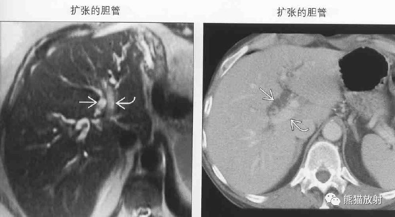 影像PPT - 肝门静脉周透亮或水肿(门静脉周围间隙增宽)-1 影像PPT - 肝门静脉周透亮或水肿(门静脉周围间隙增宽)-1