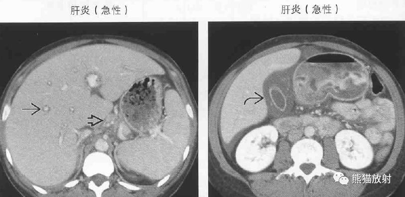 影像PPT - 肝门静脉周透亮或水肿(门静脉周围间隙增宽)-3 影像PPT - 肝门静脉周透亮或水肿(门静脉周围间隙增宽)-3
