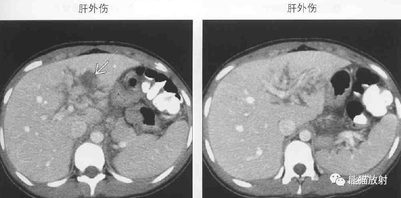影像PPT - 肝门静脉周透亮或水肿(门静脉周围间隙增宽)-6 影像PPT - 肝门静脉周透亮或水肿(门静脉周围间隙增宽)-6
