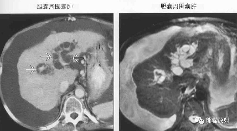 影像PPT - 肝门静脉周透亮或水肿(门静脉周围间隙增宽)-7 影像PPT - 肝门静脉周透亮或水肿(门静脉周围间隙增宽)-7