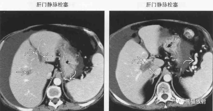 影像PPT - 肝门静脉周透亮或水肿(门静脉周围间隙增宽)-8 影像PPT - 肝门静脉周透亮或水肿(门静脉周围间隙增宽)-8