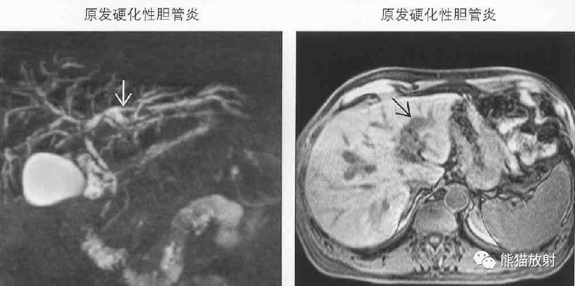影像PPT - 肝门静脉周透亮或水肿(门静脉周围间隙增宽)-9 影像PPT - 肝门静脉周透亮或水肿(门静脉周围间隙增宽)-9