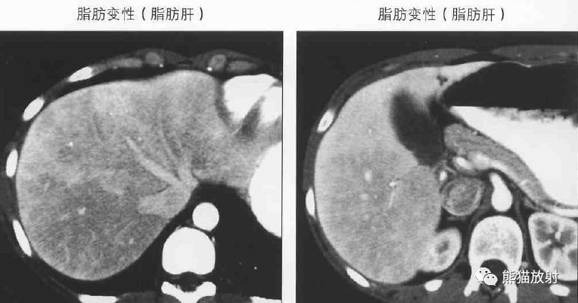影像PPT - 肝门静脉周透亮或水肿(门静脉周围间隙增宽)-10 影像PPT - 肝门静脉周透亮或水肿(门静脉周围间隙增宽)-10