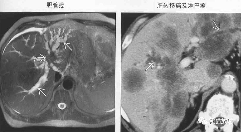 影像PPT - 肝门静脉周透亮或水肿(门静脉周围间隙增宽)-12 影像PPT - 肝门静脉周透亮或水肿(门静脉周围间隙增宽)-12