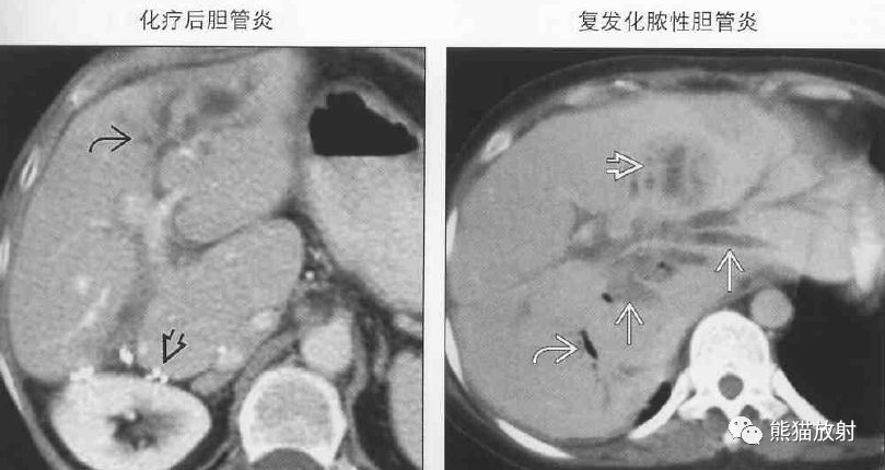 影像PPT - 肝门静脉周透亮或水肿(门静脉周围间隙增宽)-13 影像PPT - 肝门静脉周透亮或水肿(门静脉周围间隙增宽)-13