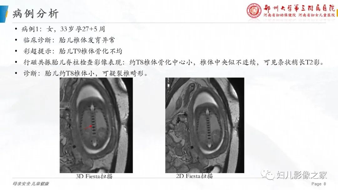 影像PPT - 【PPT】3D fiesta序列在胎儿脊柱中的应用-8