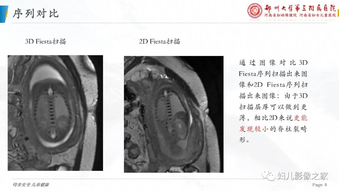 影像PPT - 【PPT】3D fiesta序列在胎儿脊柱中的应用-9