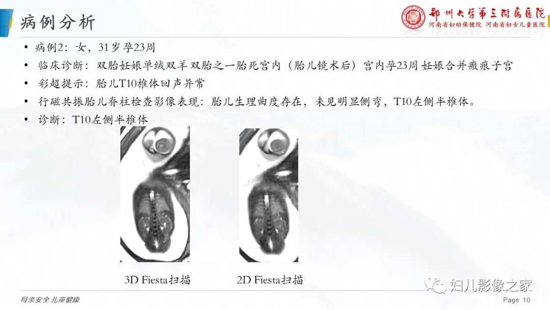 影像PPT - 【PPT】3D fiesta序列在胎儿脊柱中的应用-10