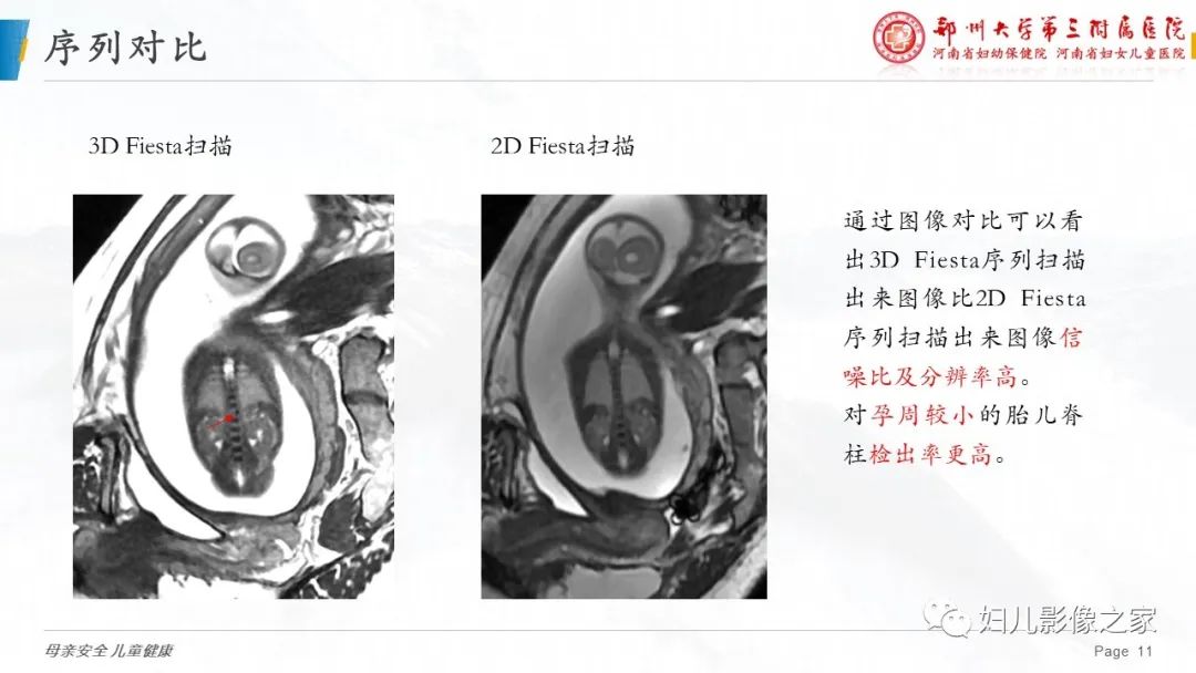 影像PPT - 【PPT】3D fiesta序列在胎儿脊柱中的应用-11