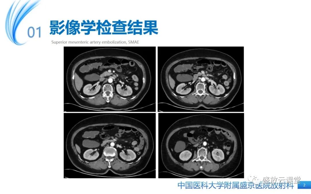 影像PPT - 【PPT】肠系膜上动脉栓塞-2