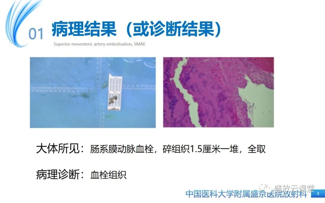 影像PPT - 【PPT】肠系膜上动脉栓塞-4