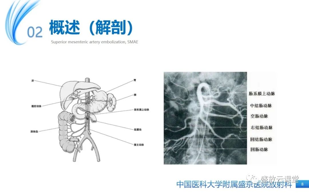 影像PPT - 【PPT】肠系膜上动脉栓塞-8