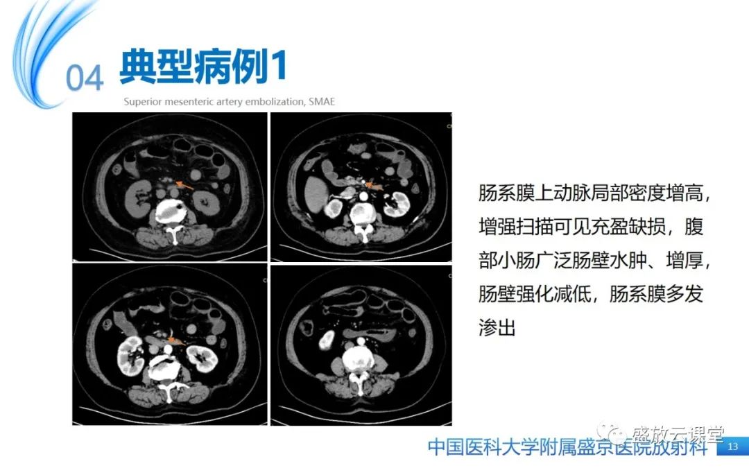 影像PPT - 【PPT】肠系膜上动脉栓塞-13