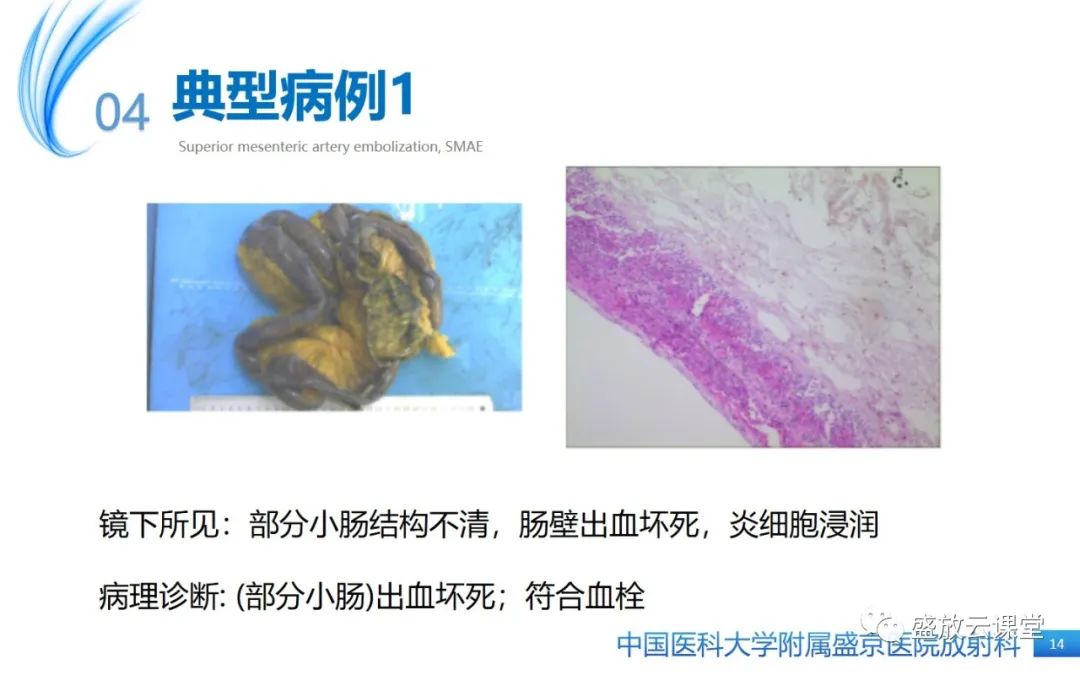 影像PPT - 【PPT】肠系膜上动脉栓塞-14