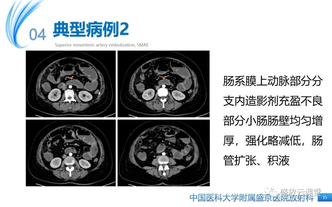 影像PPT - 【PPT】肠系膜上动脉栓塞-15