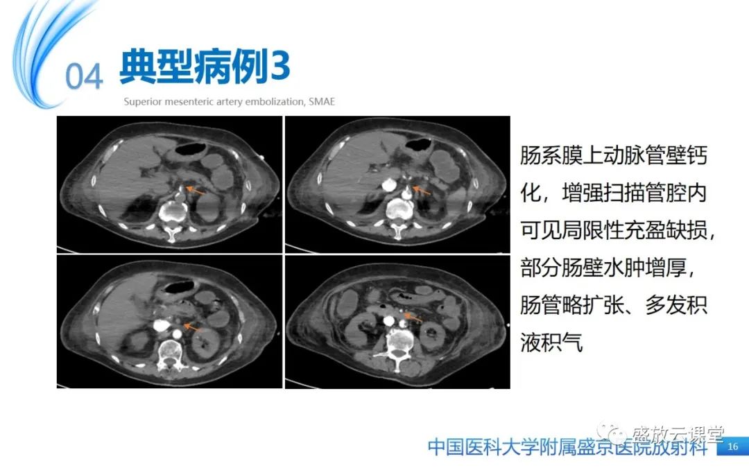 影像PPT - 【PPT】肠系膜上动脉栓塞-16