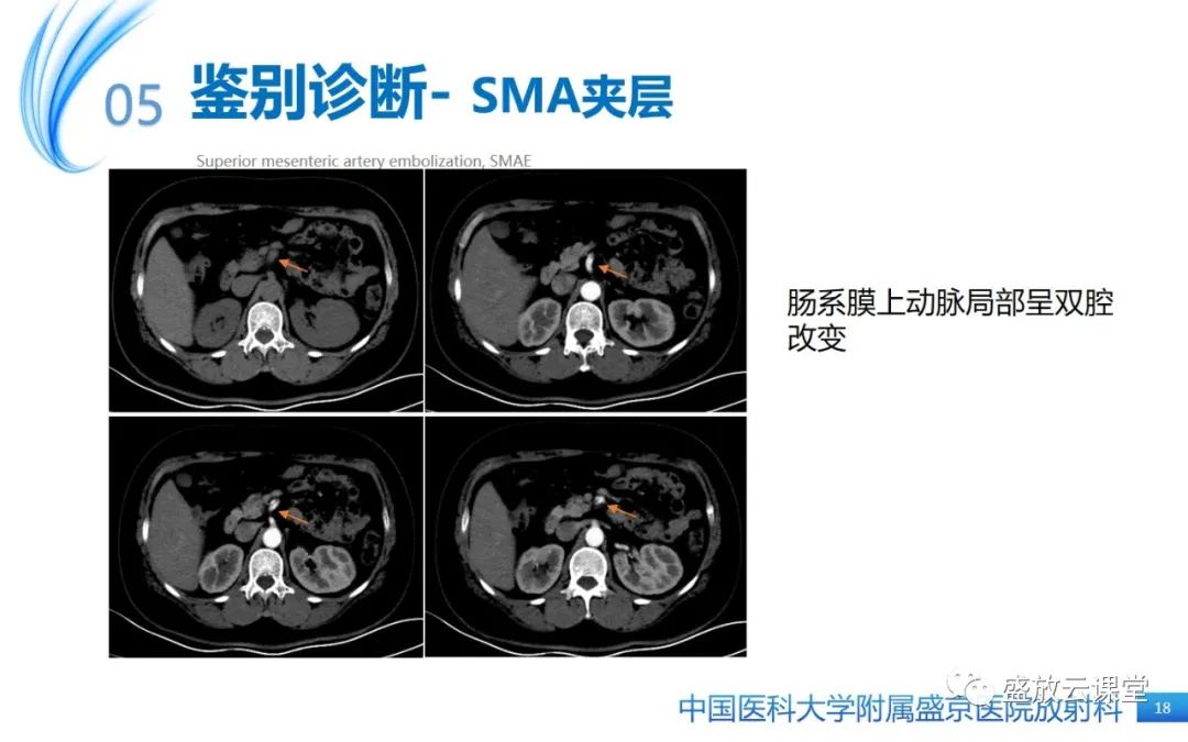 影像PPT - 【PPT】肠系膜上动脉栓塞-18