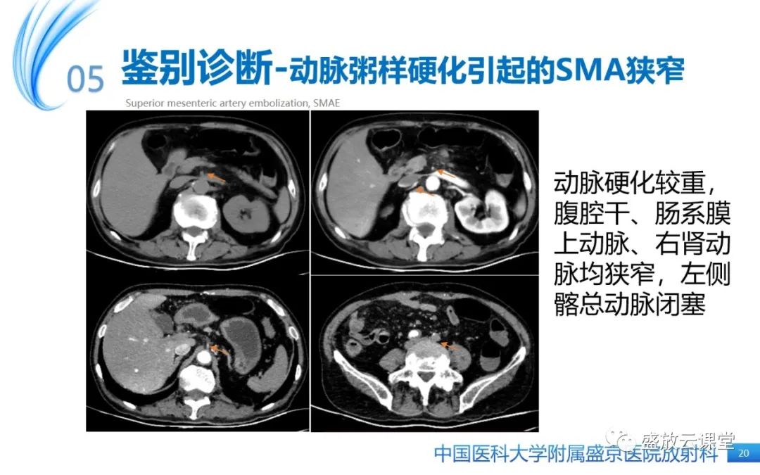 影像PPT - 【PPT】肠系膜上动脉栓塞-20