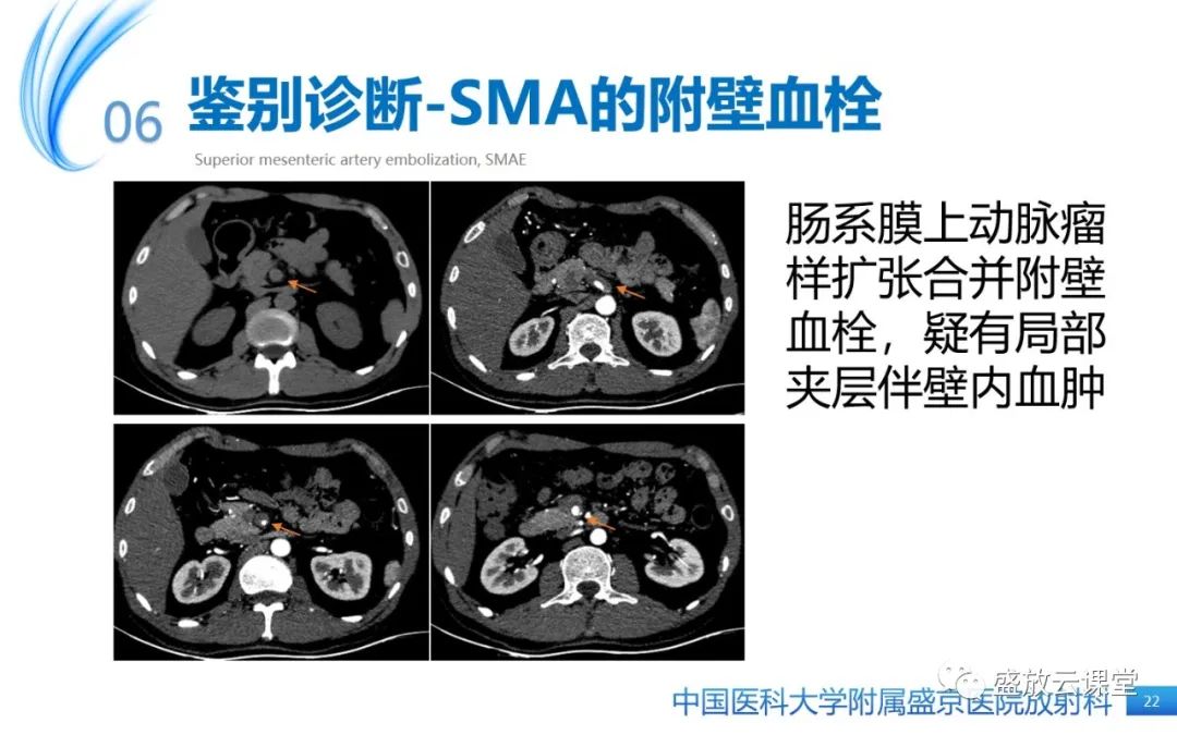 影像PPT - 【PPT】肠系膜上动脉栓塞-22