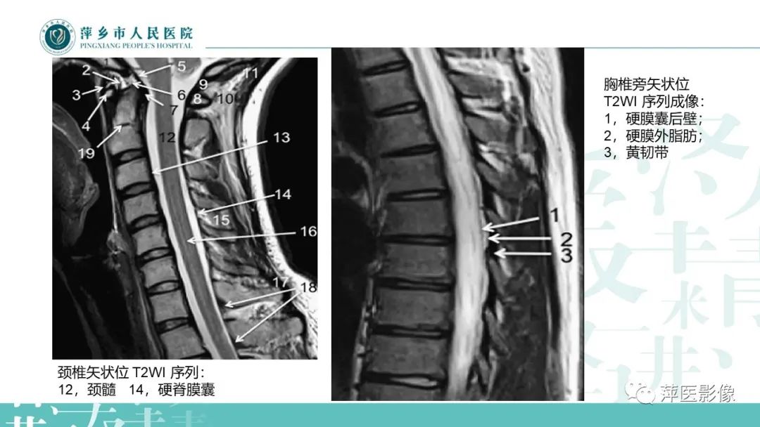 影像PPT - 【PPT】髓外硬膜内肿瘤-5