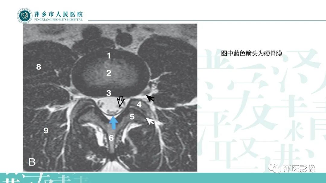 影像PPT - 【PPT】髓外硬膜内肿瘤-7